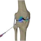 Intra-Articular Joint Injections