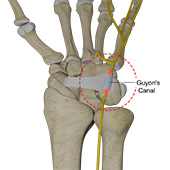 Ulnar Nerve Compression in Guyon's Canal