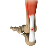 Achilles Tendon Rupture