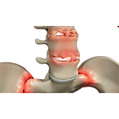 Ankylosing Spondylitis