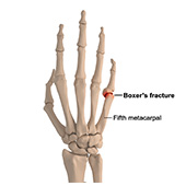 Boxer's Fracture