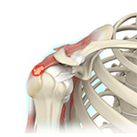 Calcification Tendinitis