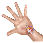 Carpal Tunnel Syndrome