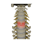 Cervical Degenerative Disc Disease