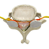 Cervical Stenosis