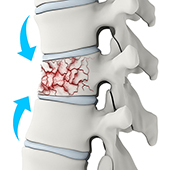 What are Vertebral Compression Fractures
