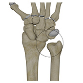 Distal Radioulnar Joint (DRUJ) Instability