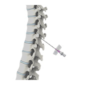 Epidural Spinal Injection