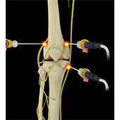 Genicular Nerve Radiofrequency Ablation