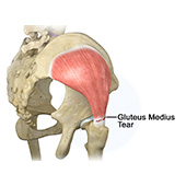 Gluteus Medius Tear