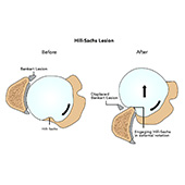 Hill-Sachs Lesion