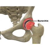 Hip Synovitis