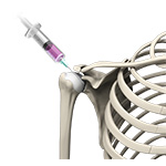 Intraarticular Shoulder Injection