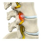 Lumbar Radiculopathy