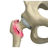 Osteoporotic Fractures