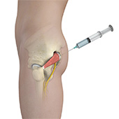 Piriformis Muscle Injection