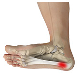 Plantar Fasciitis