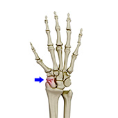 Scaphoid Fracture