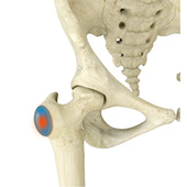 Trochanteric Bursitis