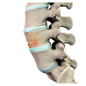 Vertebral Compression Fractures