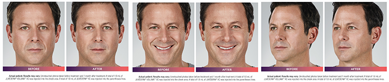 Dermal Filler Male