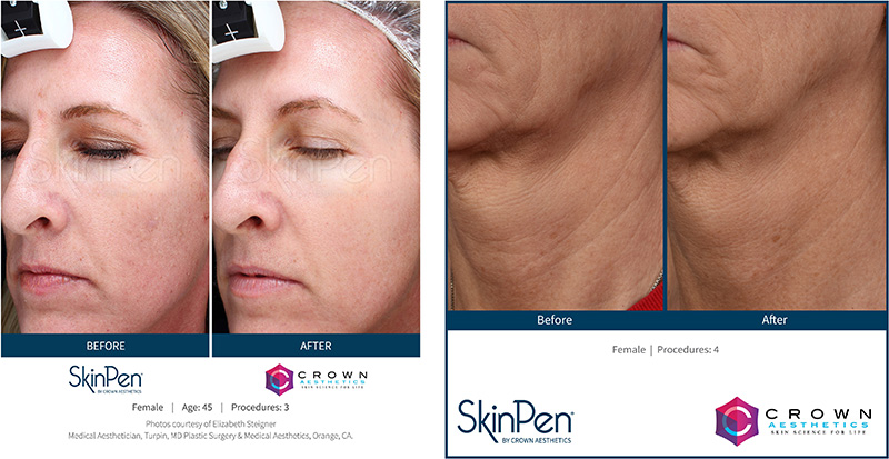 SkinPen